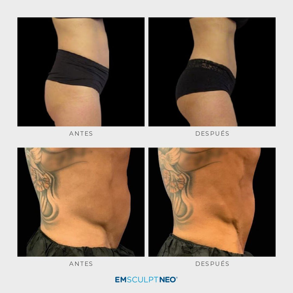 Emsculpt Neo - Pack 8 sesiones - Ro Medical