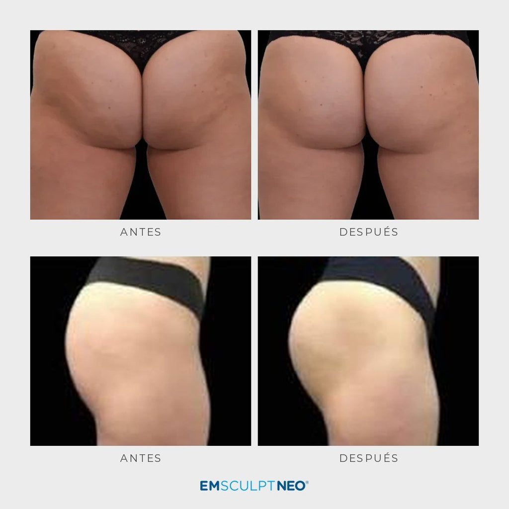 Emsculpt Neo - Pack 8 sesiones - Ro Medical
