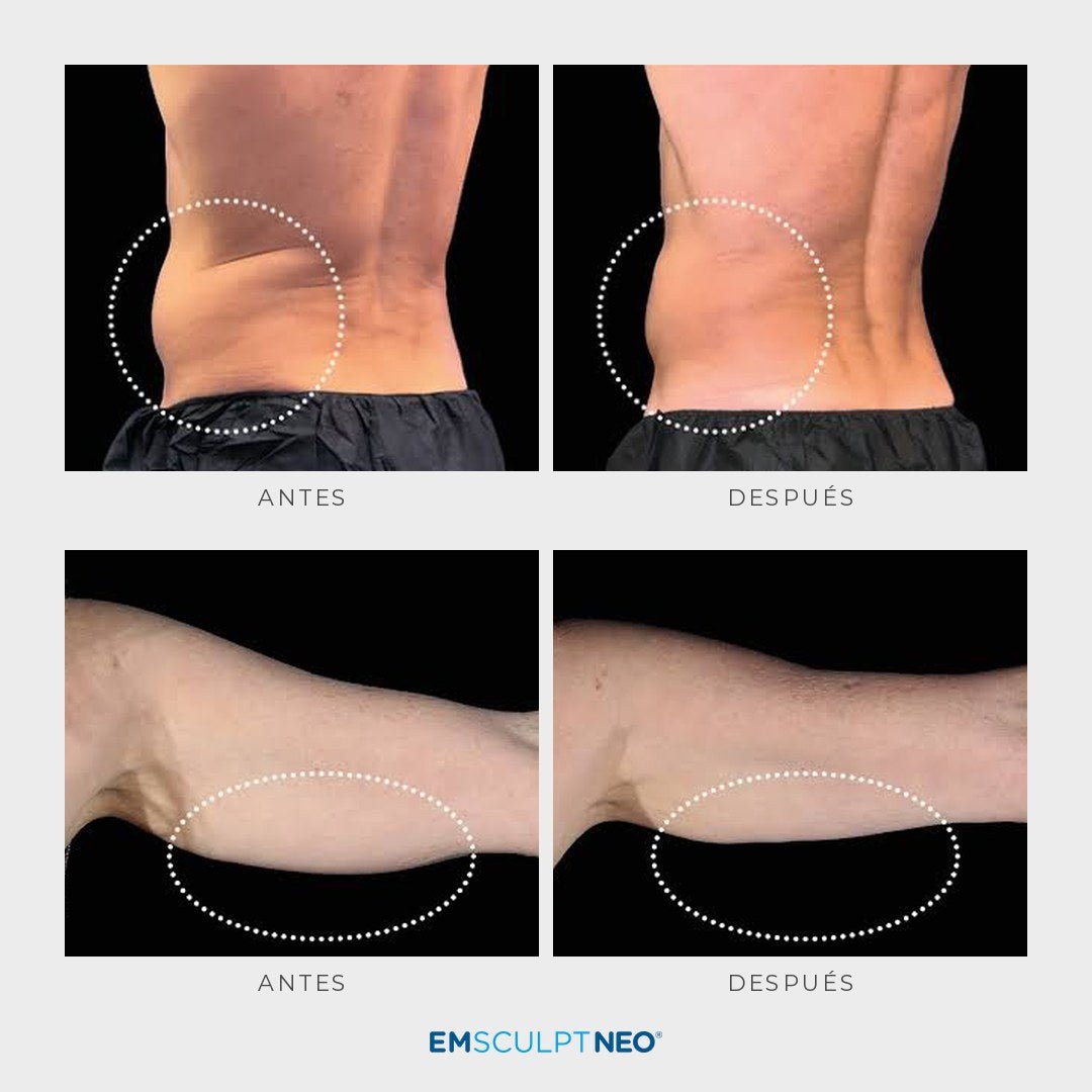 Emsculpt Neo - Pack 8 sesiones - Ro Medical