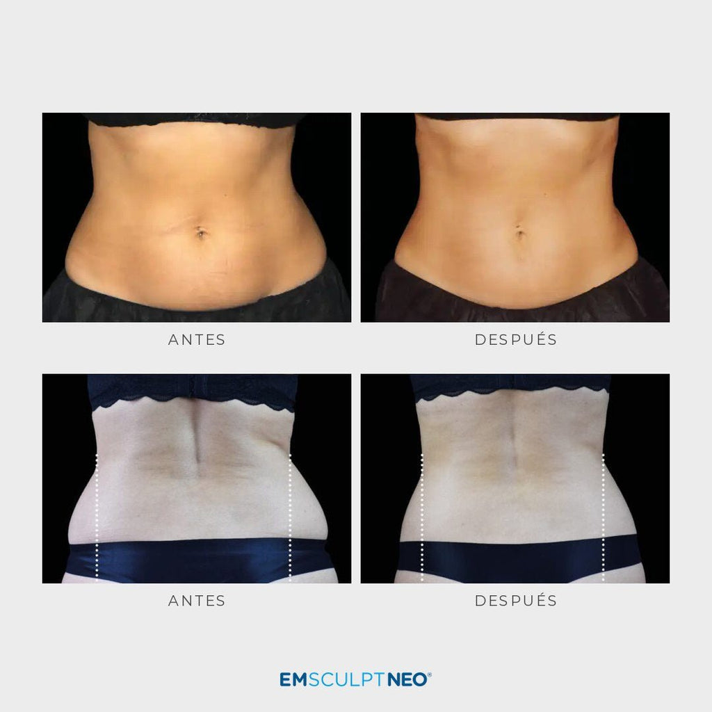 Emsculpt Neo - Pack 8 sesiones - Ro Medical
