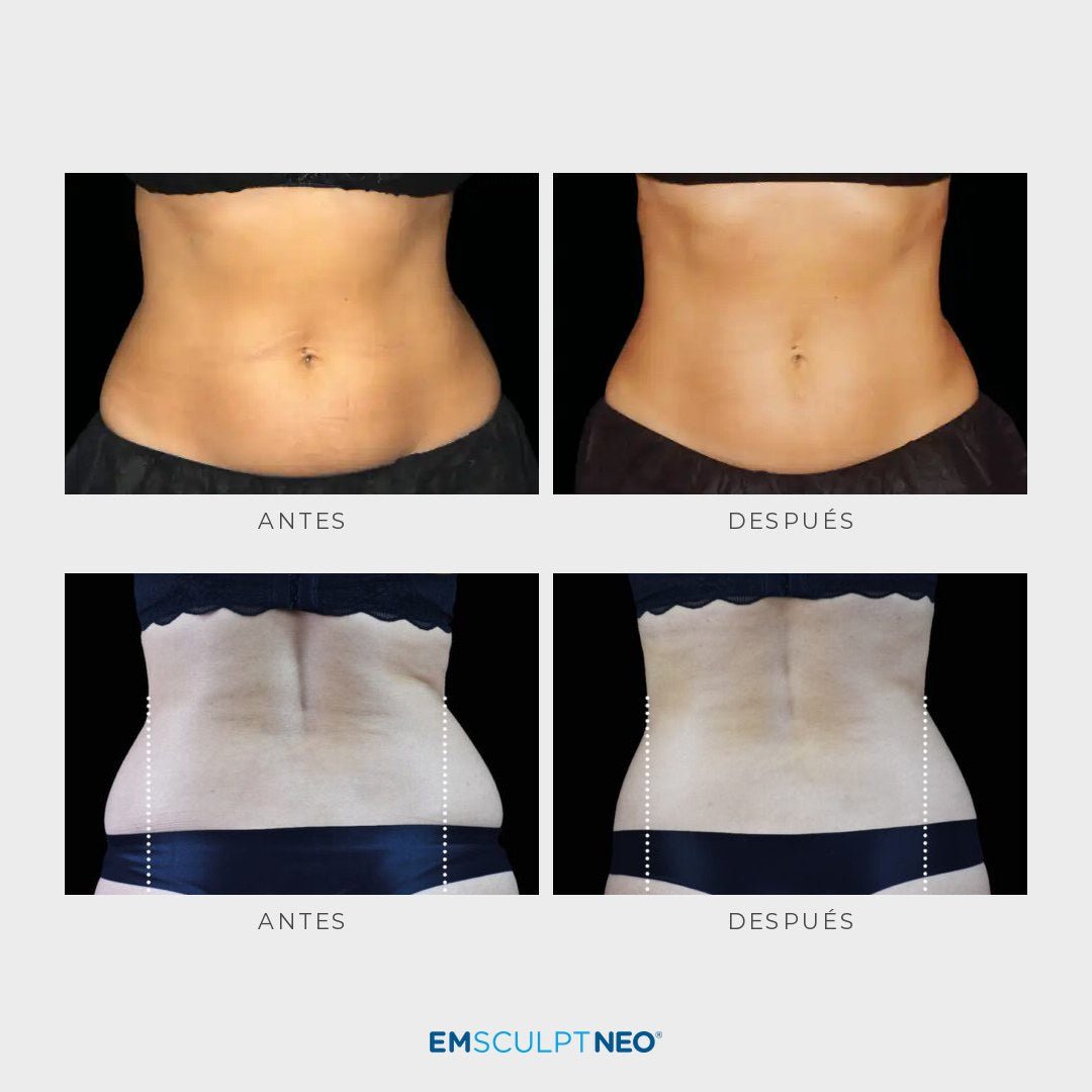 Emsculpt Neo - Pack 8 sesiones - Ro Medical