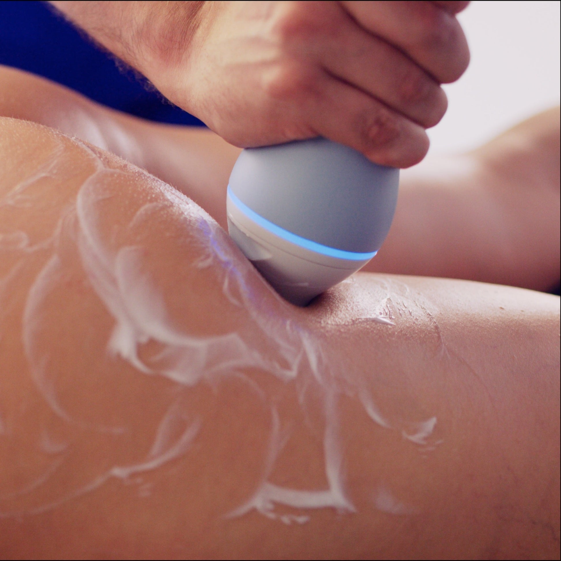 Emtone - Tratamiento para la celulitis - Ro Medical