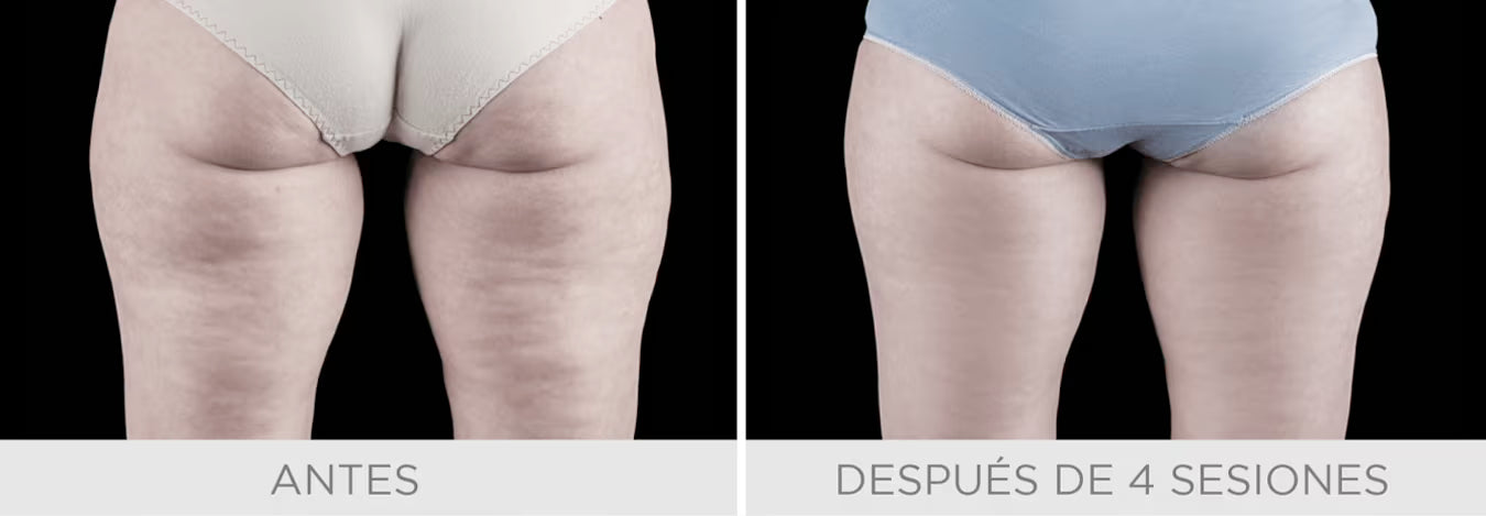 Emtone - Tratamiento para la celulitis