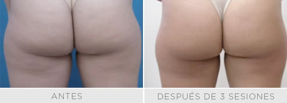 Radiofrecuencia Accent/Venus Legacy - Reduce la flacidez