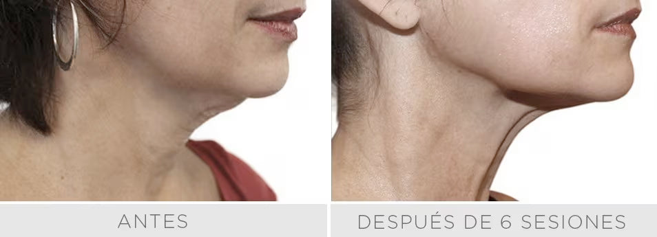 Radiofrecuencia Accent/Venus Legacy - Reduce la flacidez