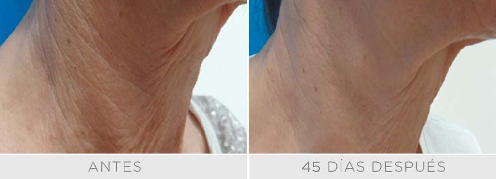 Clear Lift - Rostro 3 sesiones