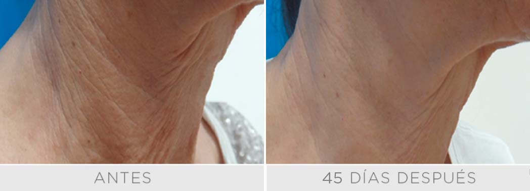 Clear Lift - Rostro 3 sesiones