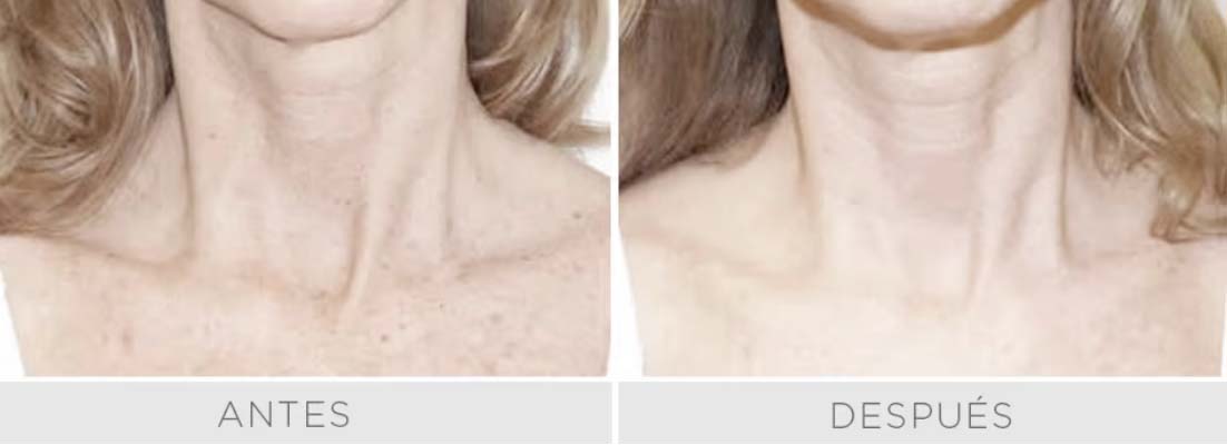 Clear Lift - Rostro 3 sesiones