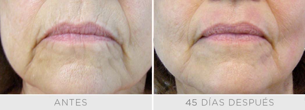 Láser Erbium - Resurfacing Ablativo - Rostro 3 sesiones