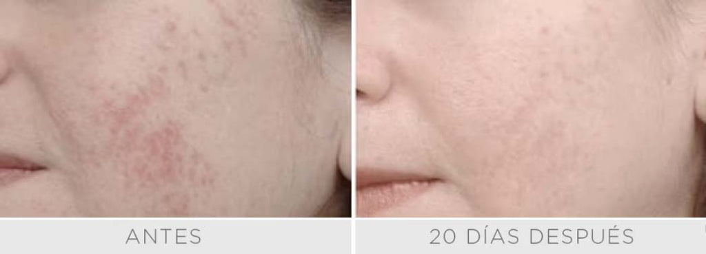 Luz Pulsada - IPL Harmony PRO - Rostro Pack 3 sesiones