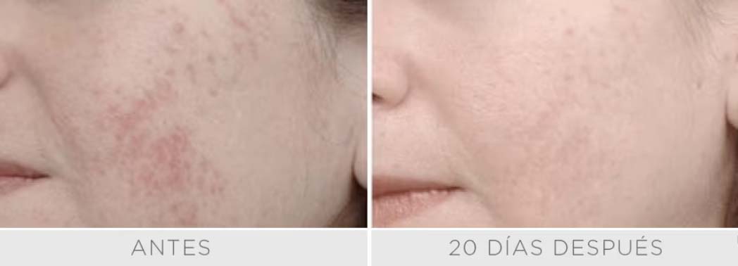 Luz Pulsada - IPL Harmony PRO - Rostro Pack 3 sesiones