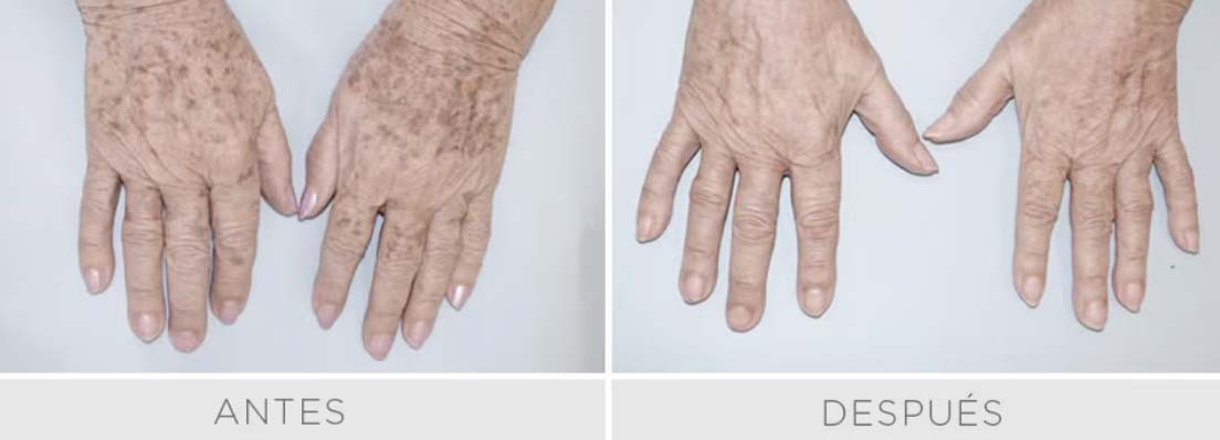 Luz Pulsada - IPL Harmony PRO - Rostro Pack 3 sesiones