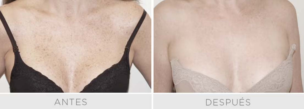 Luz Pulsada - IPL Harmony PRO - Rostro Pack 3 sesiones