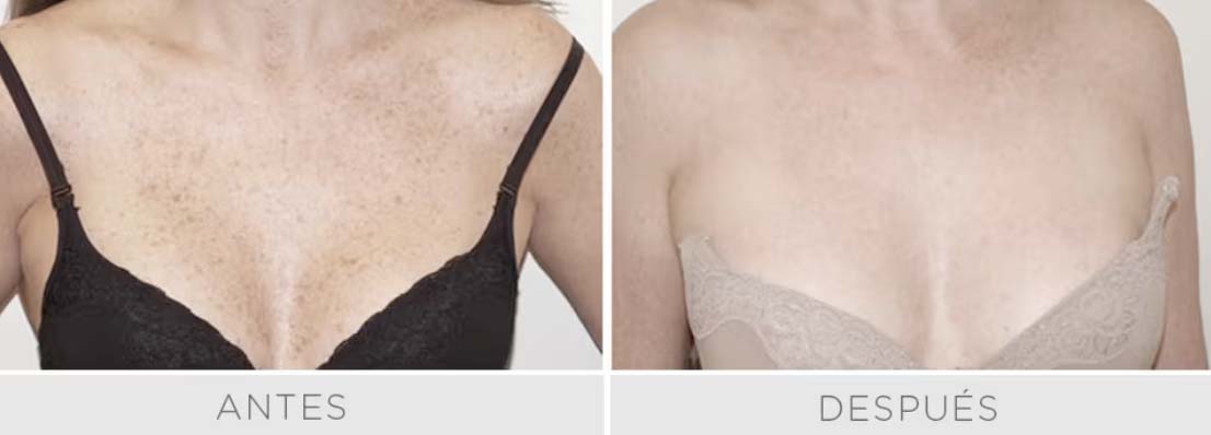 Luz Pulsada - IPL Harmony PRO - Rostro Pack 3 sesiones