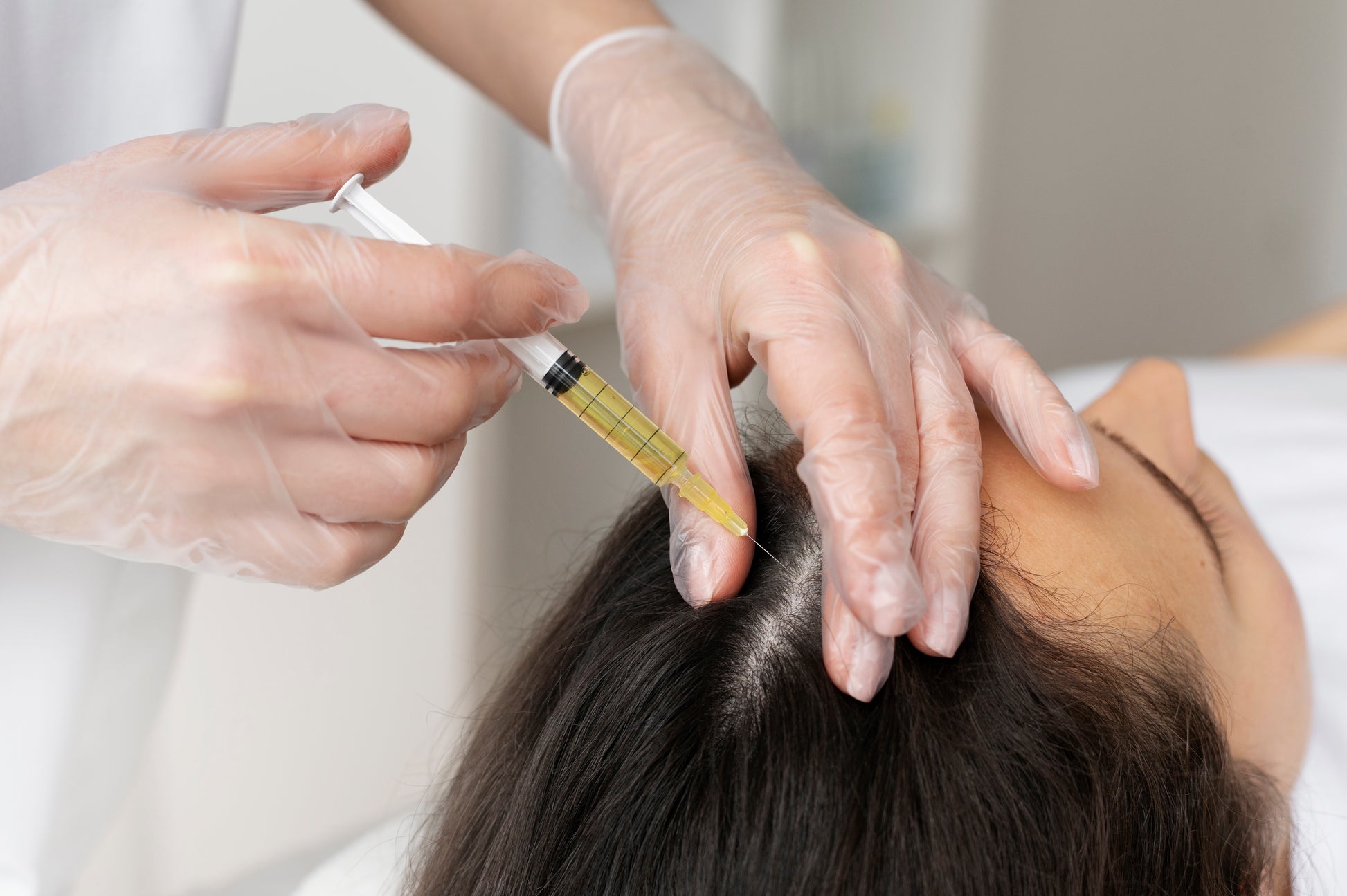 Mesoterapia española RRS XL HAIR (Tratamiento completo - 6 sesiones)