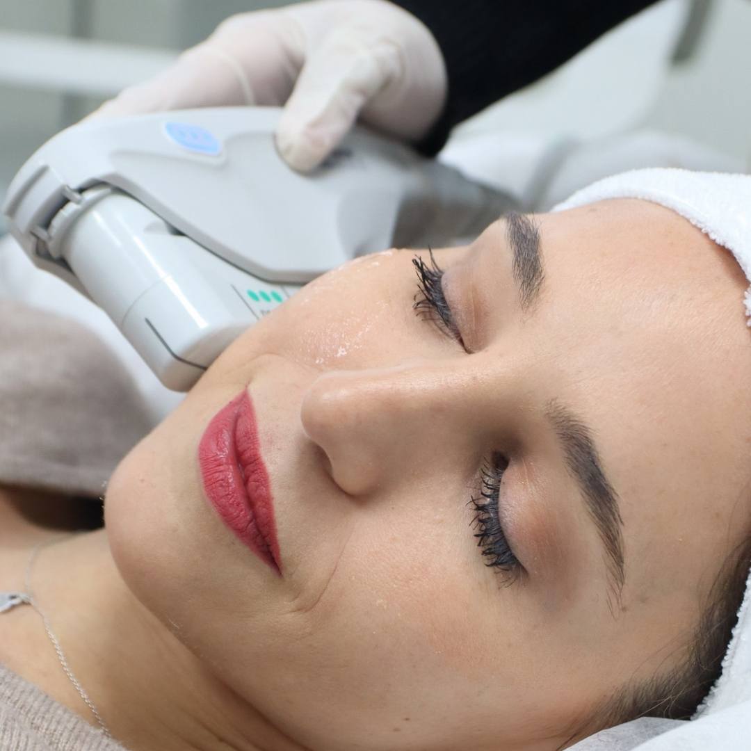 Ultherapy - Lifting sin cirugía - Rostro Inferior 650 lÍneas - Ro Medical