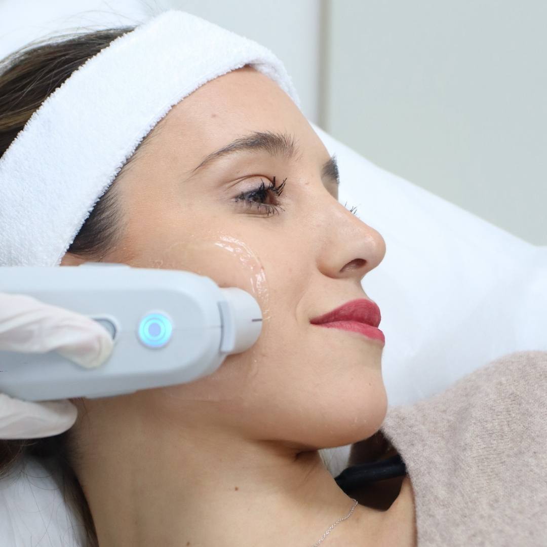 Ultherapy - Lifting sin cirugía - Rostro Superior 150 líneas - Ro Medical